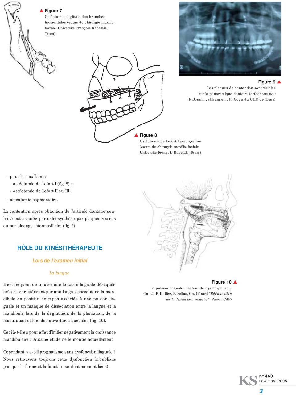 Bonnin ; chirurgien : Pr Goga du CHU de Tours) Figure 8 Ostéotomie de Lefort I avec greffon (cours de chirurgie maxillo-faciale.