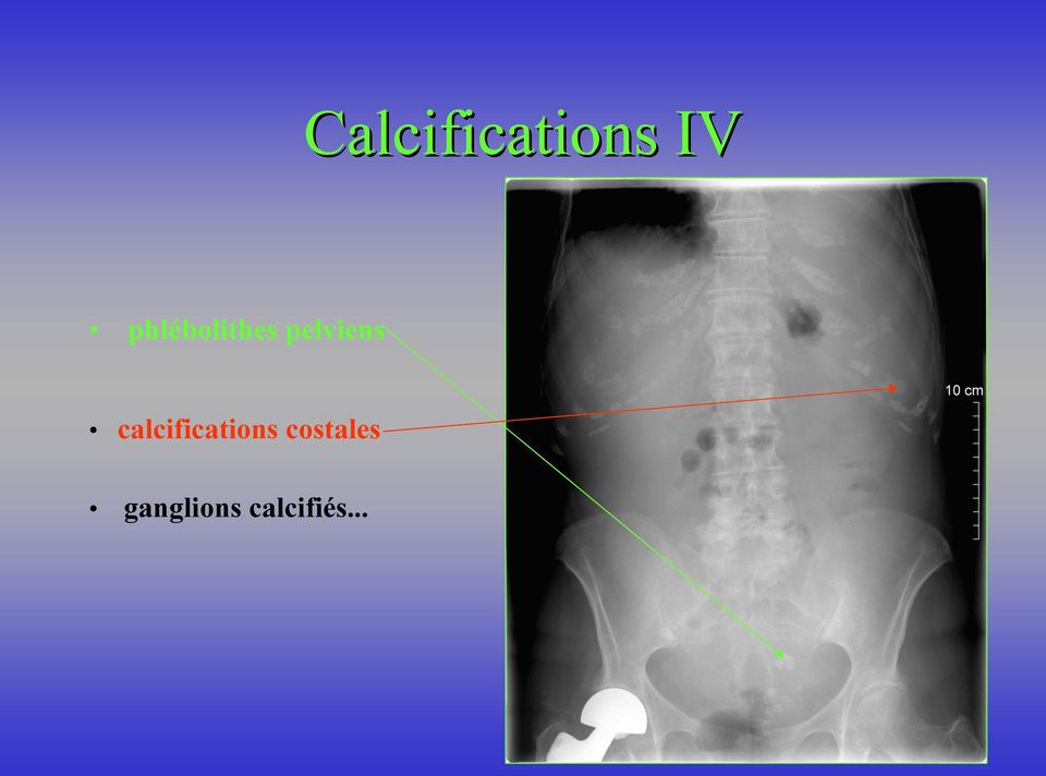 calcifications