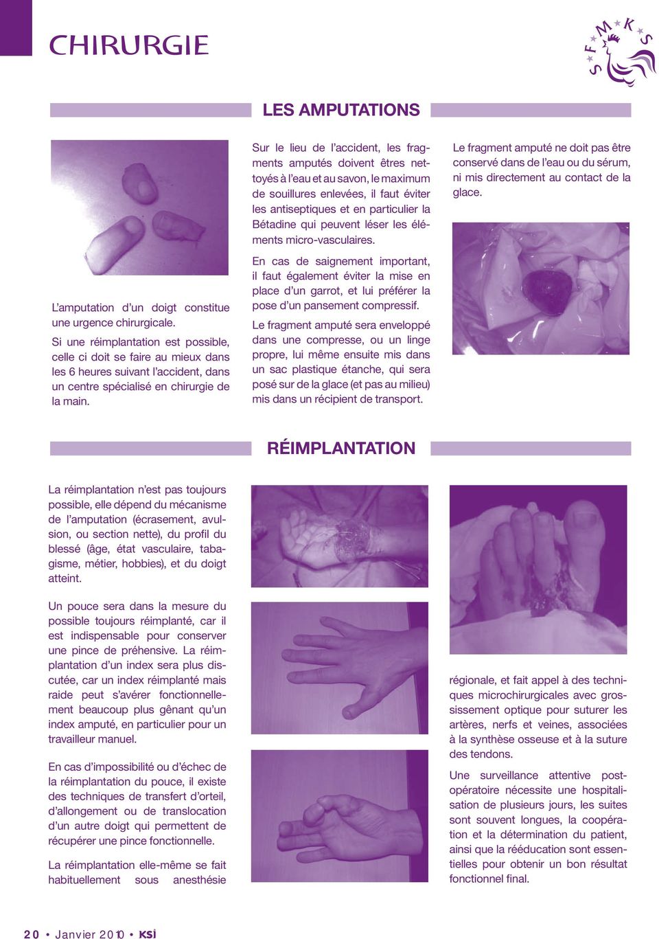 L amputation d un doigt constitue une urgence chirurgicale.