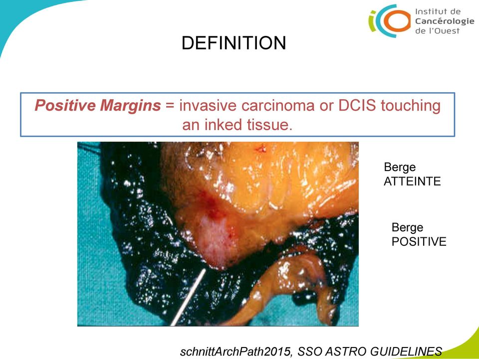 = invasive carcinoma or DCIS touching