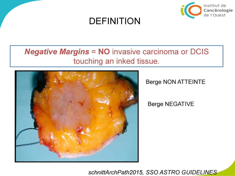 NO invasive carcinoma or DCIS touching