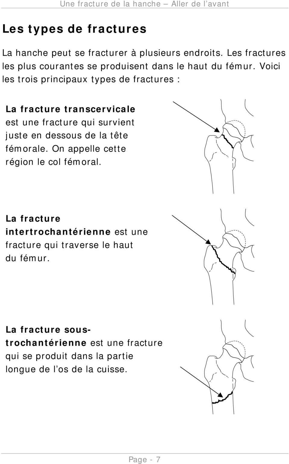 Voici les trois principaux types de fractures : La fracture transcervicale est une fracture qui survient juste en dessous de la