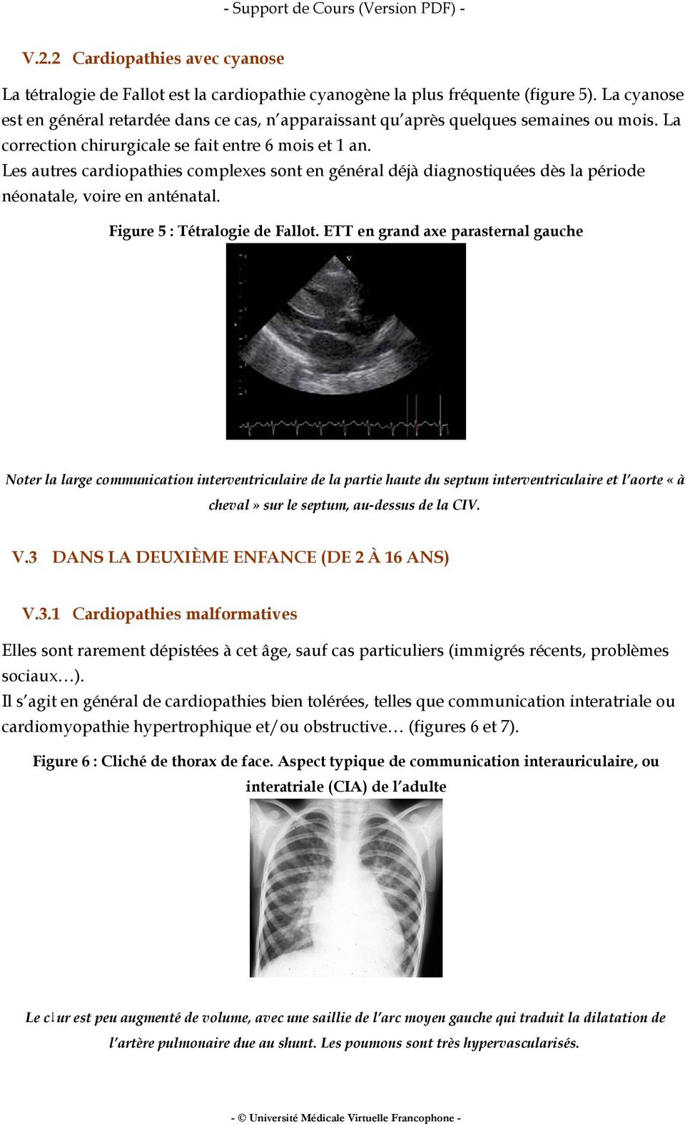 Les autres cardiopathies complexes sont en général déjà diagnostiquées dès la période néonatale, voire en anténatal. Figure 5 : Tétralogie de Fallot.
