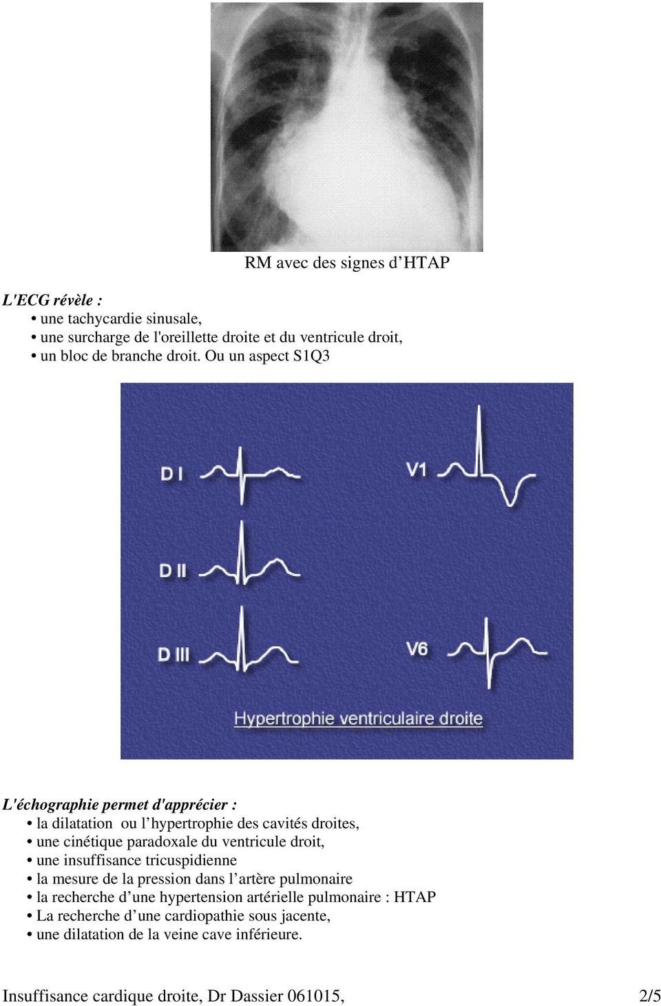 Ou un aspect S1Q3 L'échographie permet d'apprécier : la dilatation ou l hypertrophie des cavités droites, une cinétique paradoxale du ventricule
