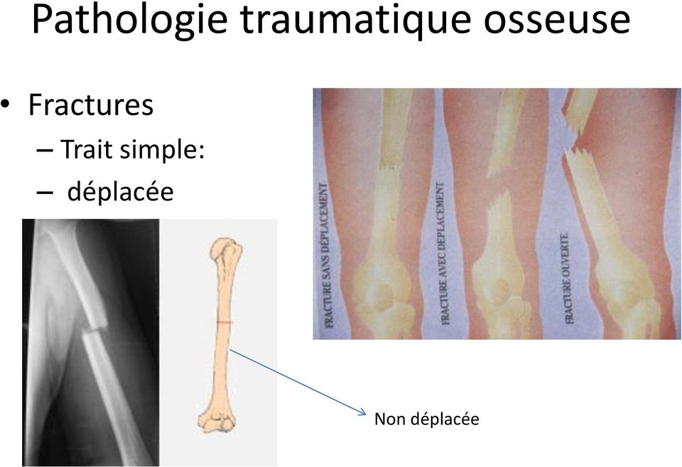 osseuse Fractures