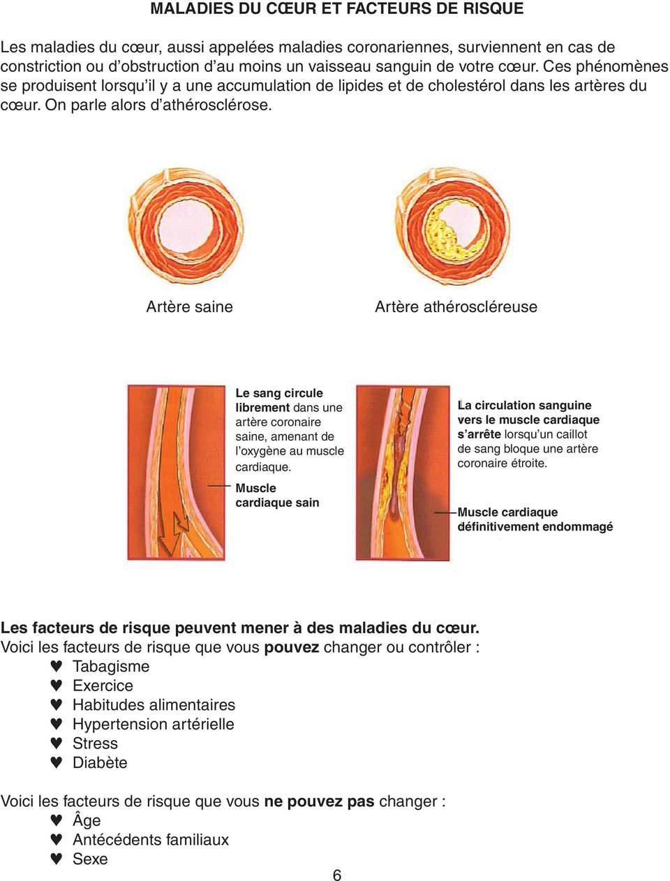 Artère saine Artère athéroscléreuse Le sang circule librement dans une artère coronaire saine, amenant de l oxygène au muscle cardiaque.