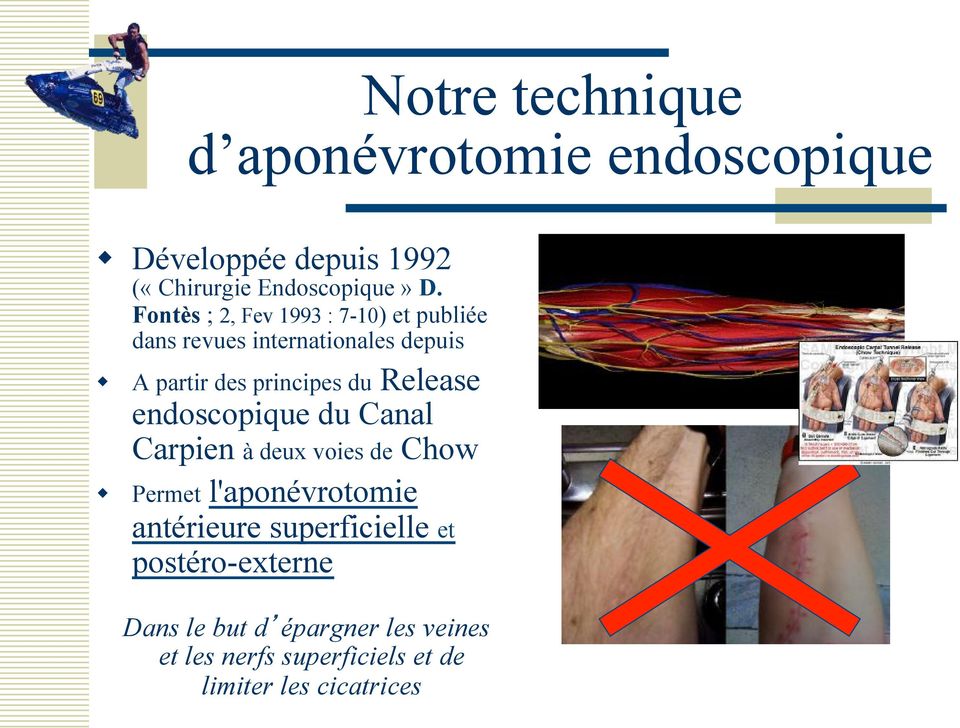 Release endoscopique du Canal Carpien à deux voies de Chow w Permet l'aponévrotomie antérieure