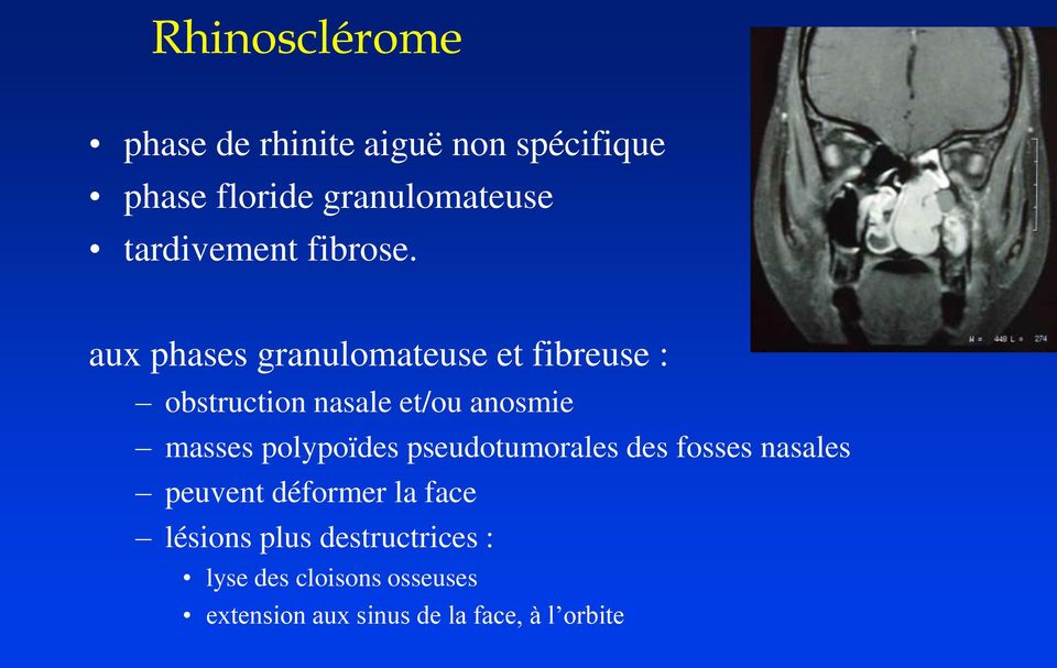 aux phases granulomateuse et fibreuse : obstruction nasale et/ou anosmie masses