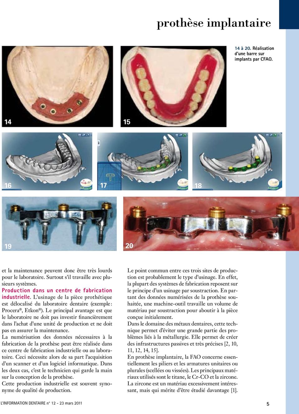 L usinage de la pièce prothétique est délocalisé du laboratoire dentaire (exemple : Procera, Etkon ).