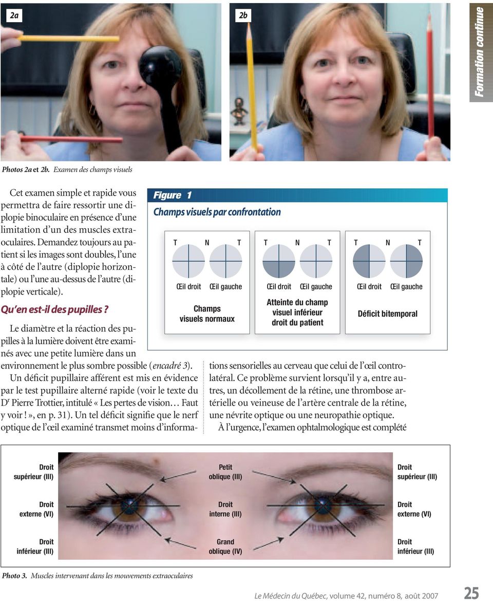 Demandez toujours au patient si les images sont doubles, l une à côté de l autre (diplopie horizontale) ou l une au-dessus de l autre (diplopie verticale). Qu en est-il des pupilles?