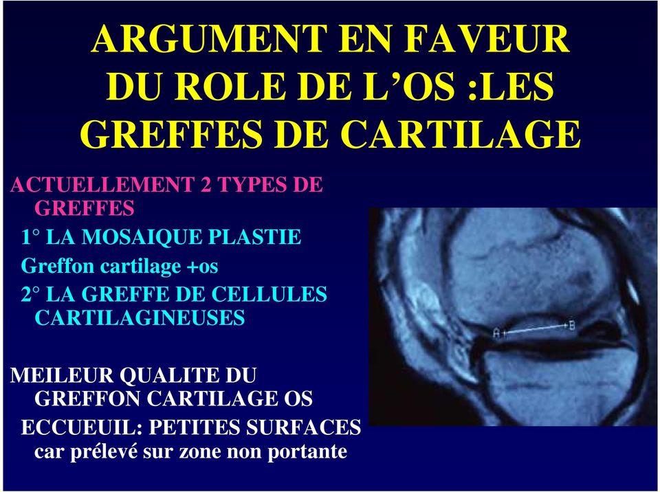 cartilage +os 2 LA GREFFE DE CELLULES CARTILAGINEUSES MEILEUR QUALITE