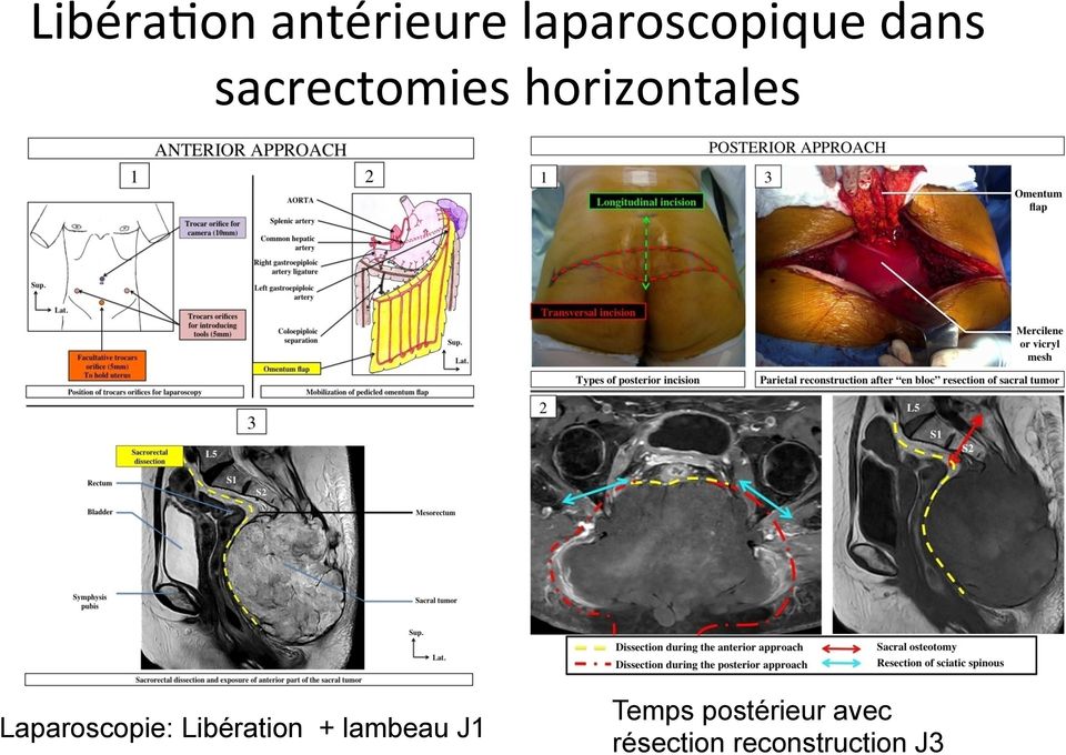 Laparoscopie: Libération + lambeau J1