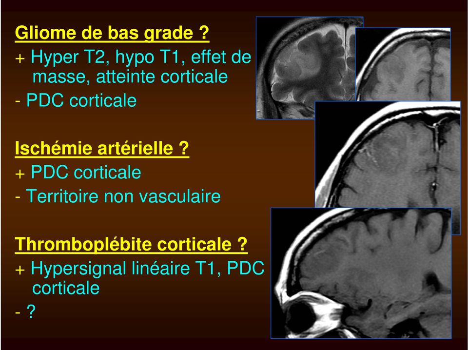 - PDC corticale Ischémie artérielle?