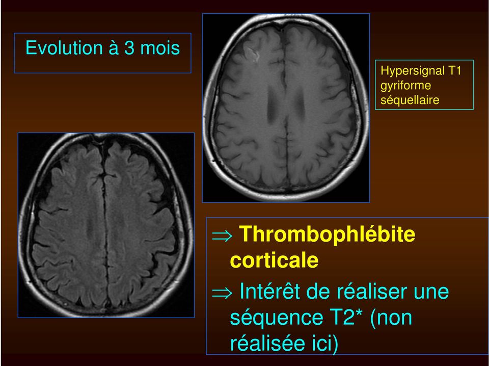 Thrombophlébite corticale Intérêt