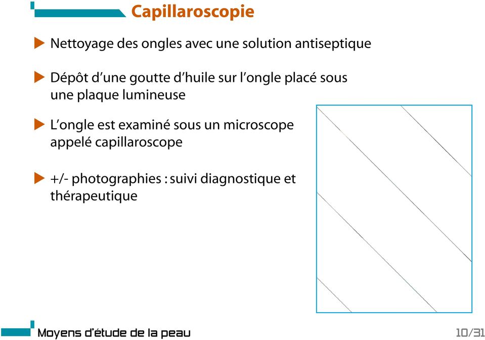 L ongle est examiné sous un microscope appelé capillaroscope +/-