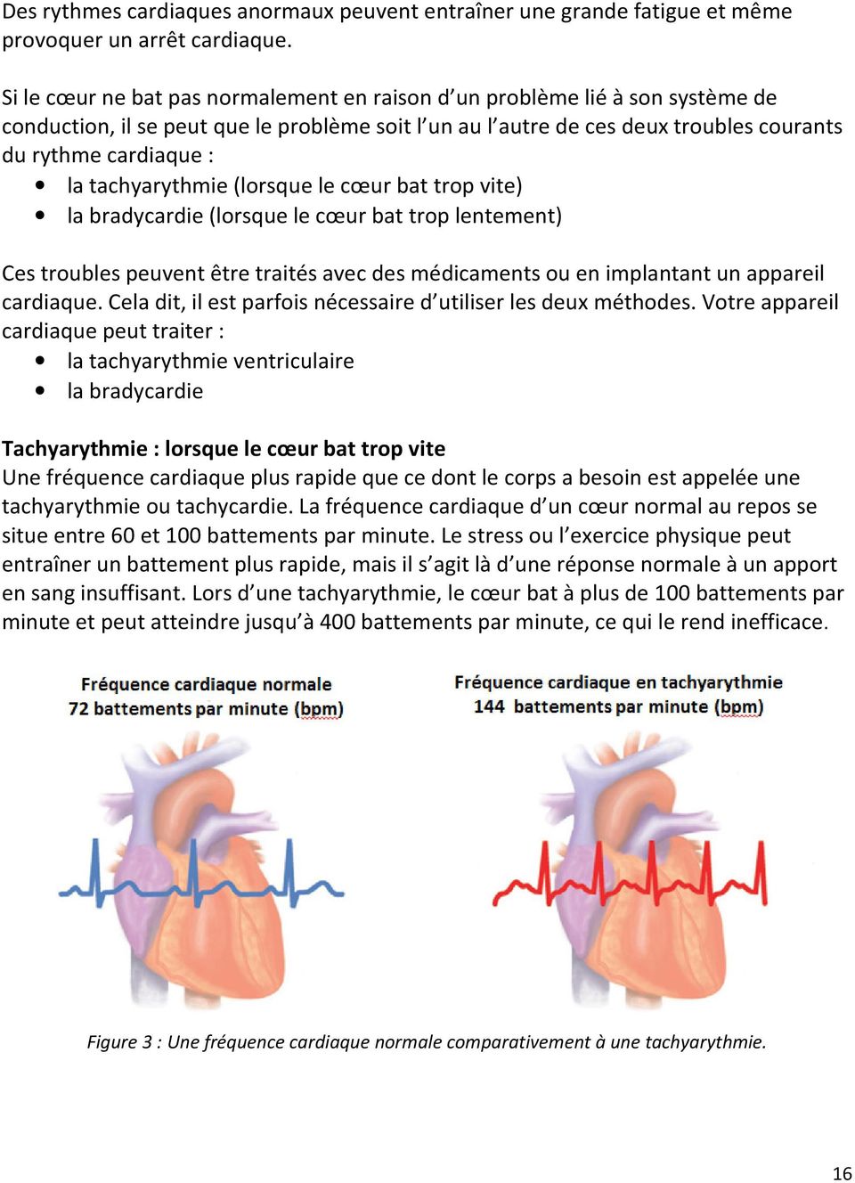 tachyarythmie (lorsque le cœur bat trop vite) la bradycardie (lorsque le cœur bat trop lentement) Ces troubles peuvent être traités avec des médicaments ou en implantant un appareil cardiaque.
