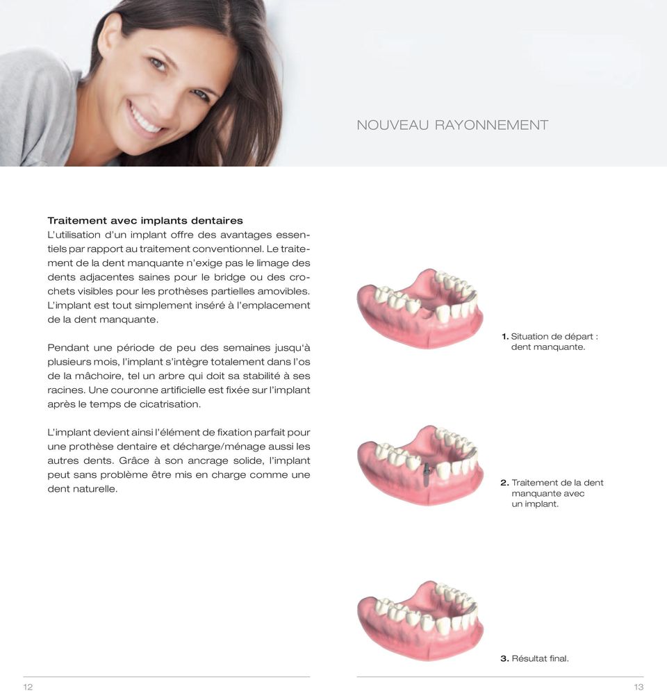 L implant est tout simplement inséré à l emplacement de la dent manquante.