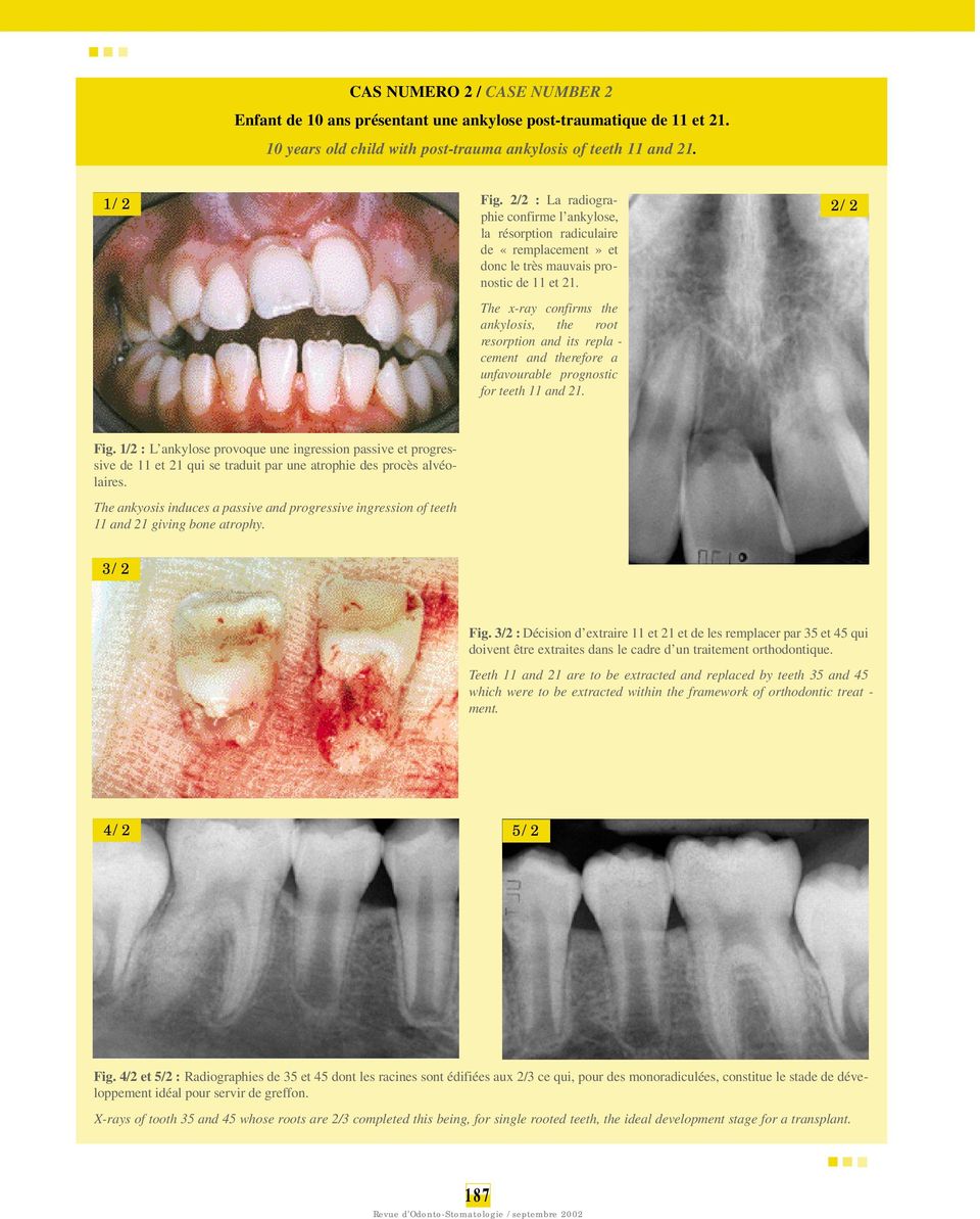 The x-ray confirms the ankylosis, the ro o t resorption and its repla - cement and there f o re a unfavourable pro g n o s t i c for teeth 11 and 21. 2/2 Fig.