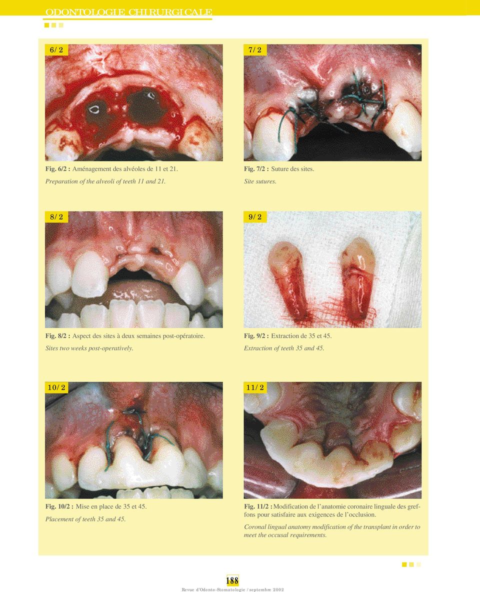 Extraction of teeth 35 and 45. 10/2 11/2 Fig.