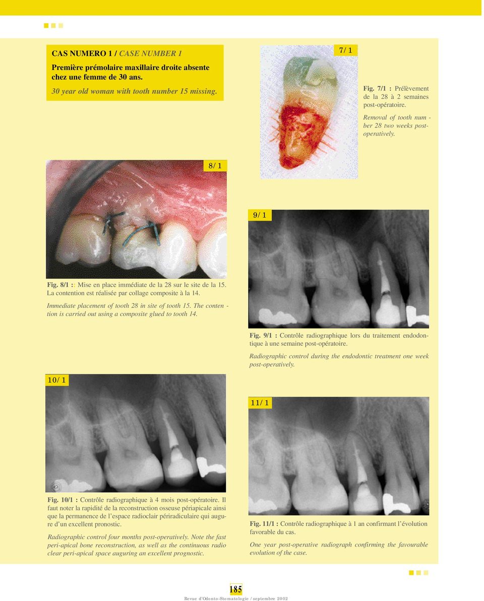 La contention est réalisée par collage composite à la 14. Immediate placement of tooth 28 in site of tooth 15. The conten - tion is carried out using a composite glued to tooth 14. Fig.