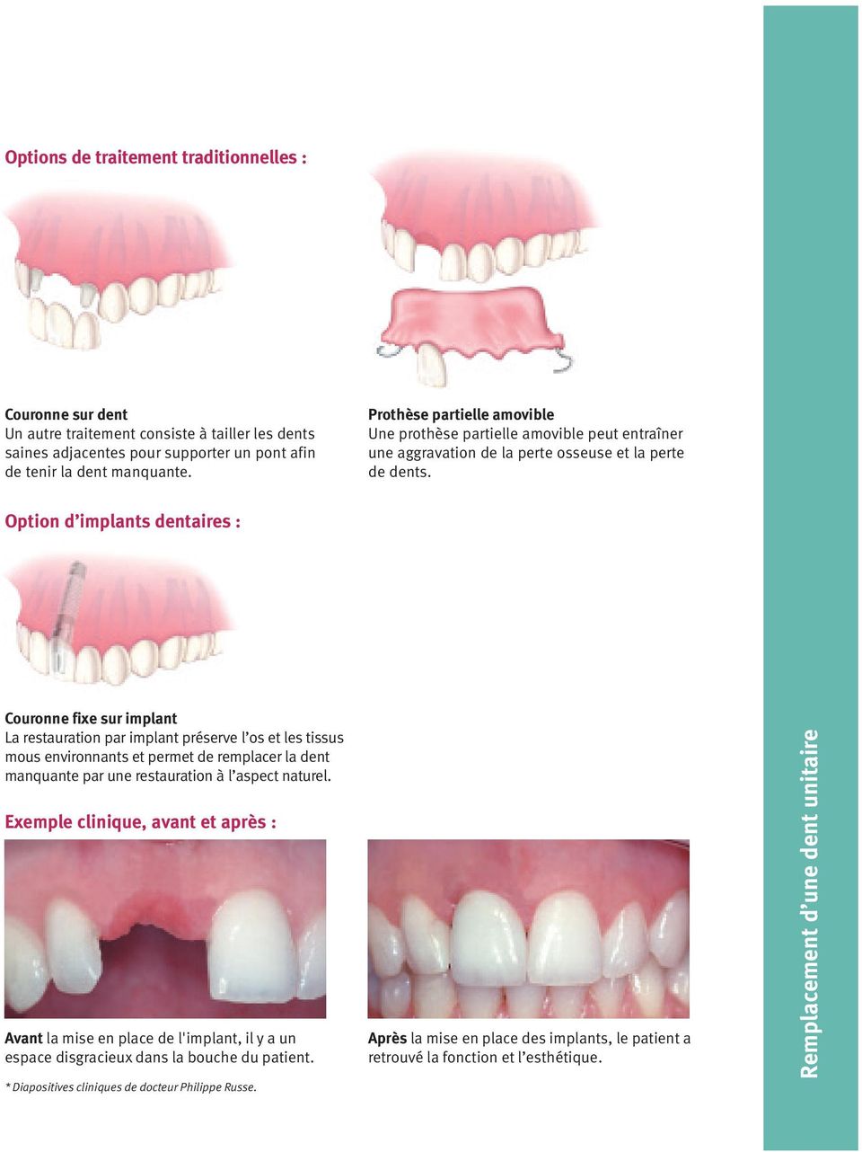 Option d implants dentaires : Couronne fixe sur implant La restauration par implant préserve l os et les tissus mous environnants et permet de remplacer la dent manquante par une restauration à l