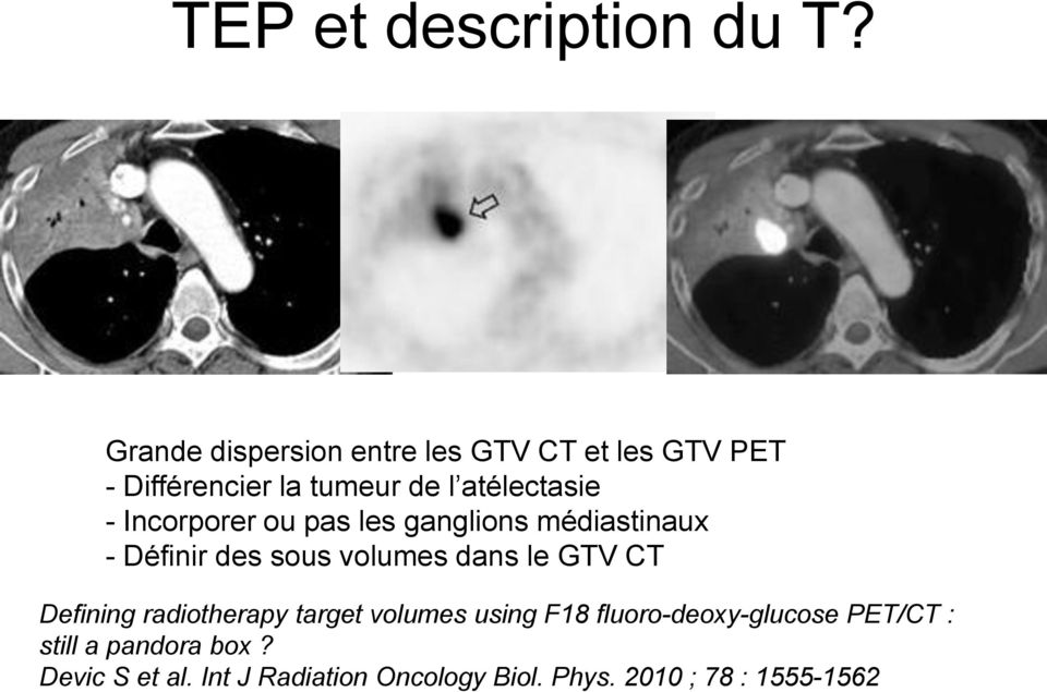 Incorporer ou pas les ganglions médiastinaux - Définir des sous volumes dans le GTV CT