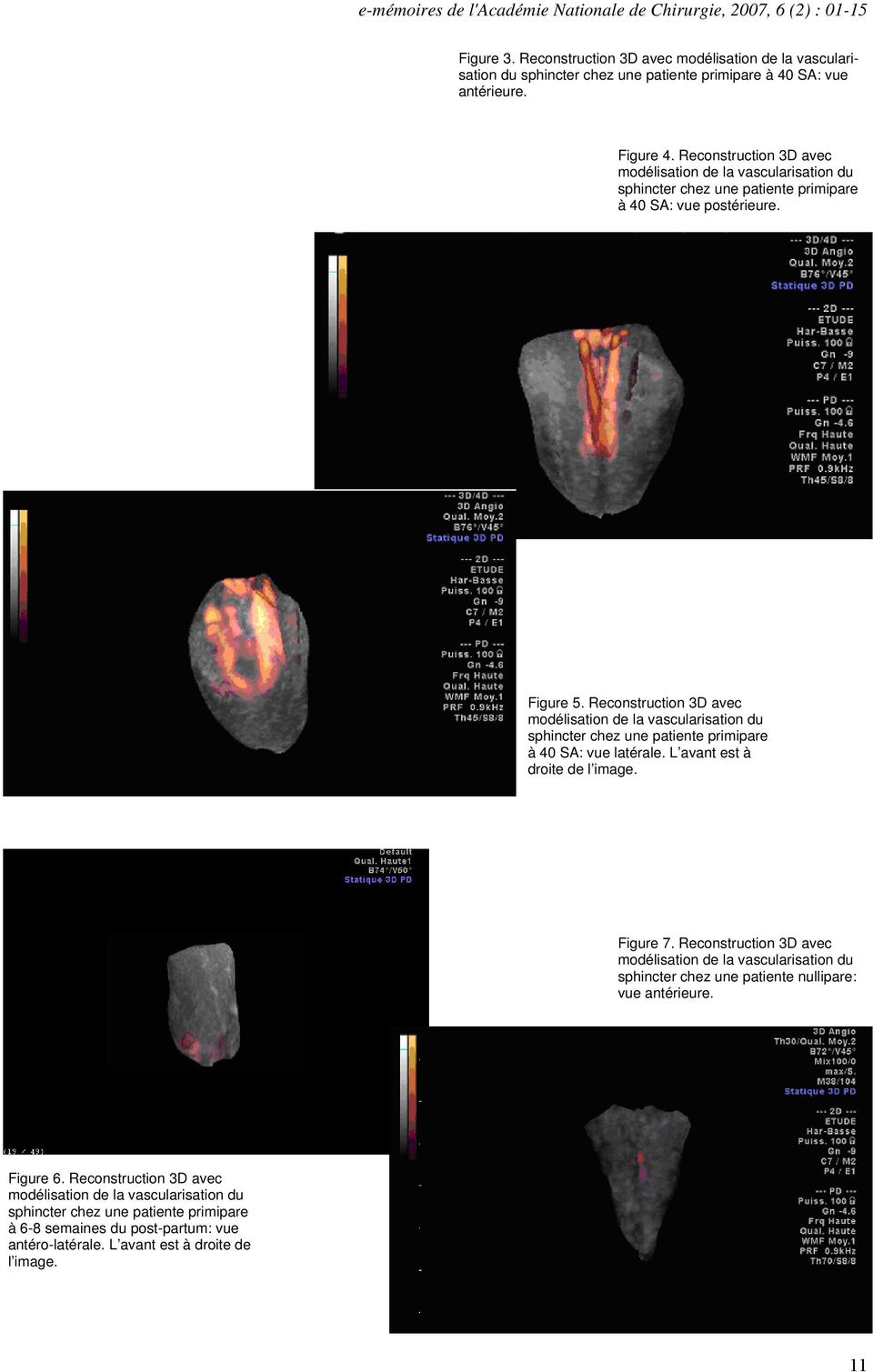 Reconstruction 3D avec modélisation de la vascularisation du sphincter chez une patiente primipare à 40 SA: vue latérale. L avant est à droite de l image. Figure 7.