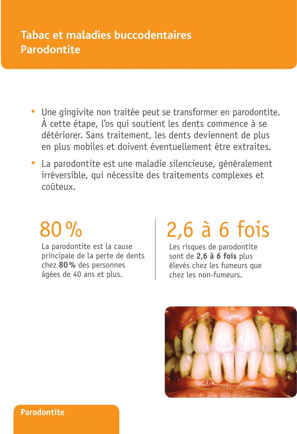 Sans traitement, les dents deviennent de plus en plus mobiles et doivent éventuellement être extraites.