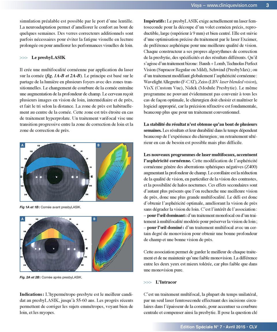 >>> Le presbylasik Il crée une multifocalité cornéenne par application du laser sur la cornée (fig. 1A-B et 2A-B).