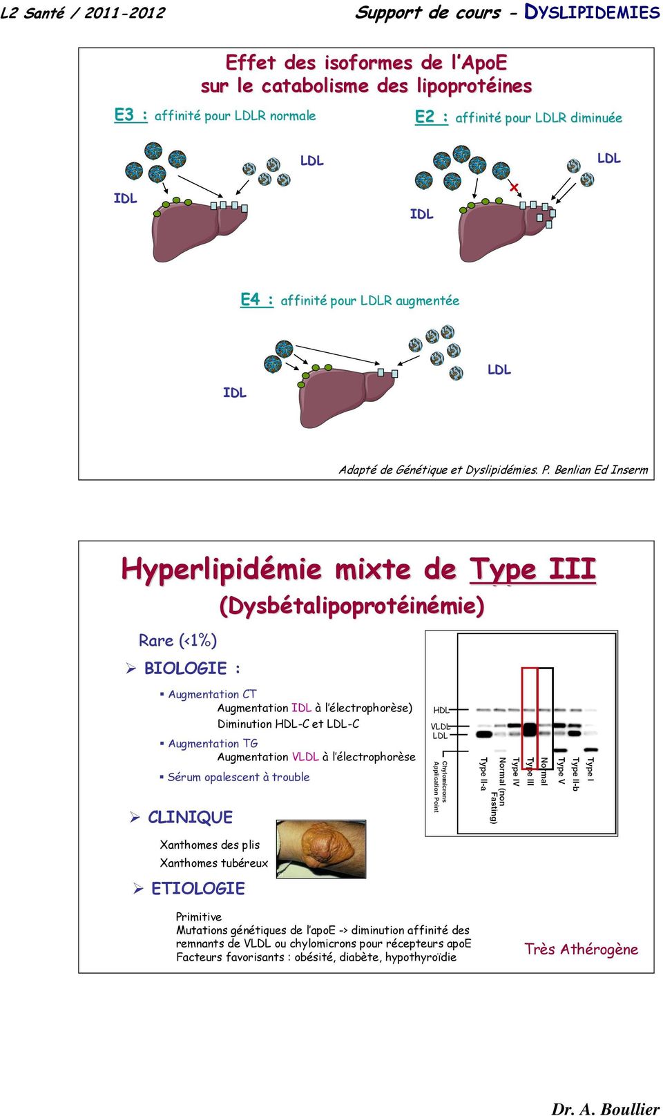 Benlian Ed Inserm Hyperlipidémie mixte de Type III (Dysbétalipoprotéinémie) Rare (<1%) BIOLOGIE : Augmentation CT Augmentation IDL à l électrophorèse) Diminution HDL-C et -C Augmentation TG