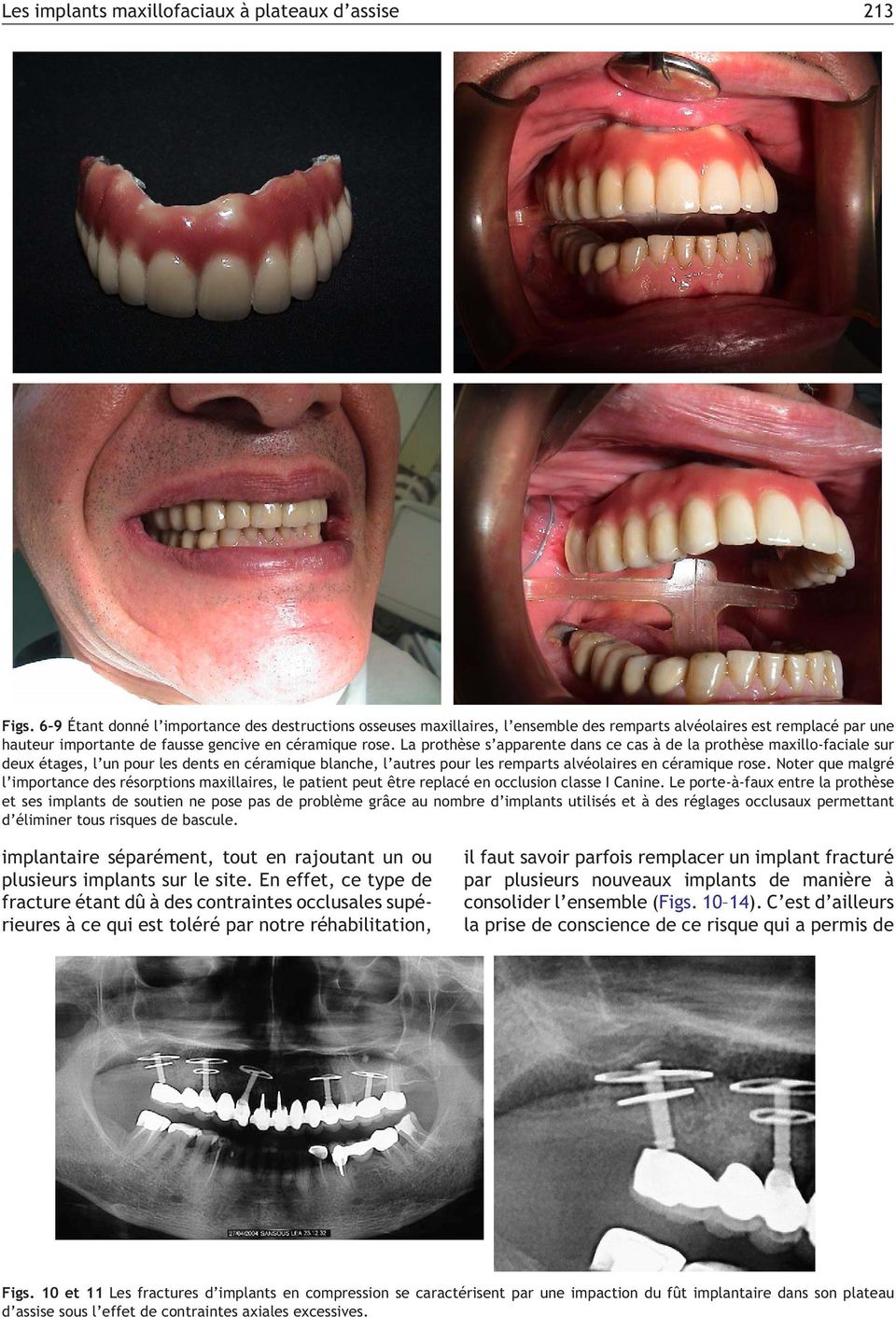 La prothèse s apparente dans ce cas à de la prothèse maxillo-faciale sur deux étages, l un pour les dents en céramique blanche, l autres pour les remparts alvéolaires en céramique rose.