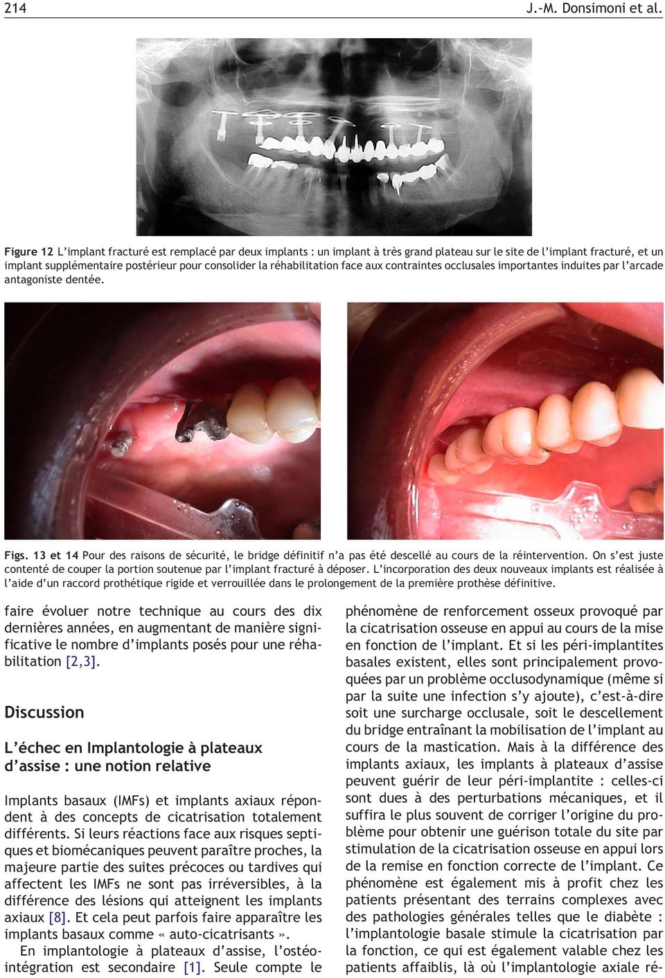 réhabilitation face aux contraintes occlusales importantes induites par l arcade antagoniste dentée. Figs.
