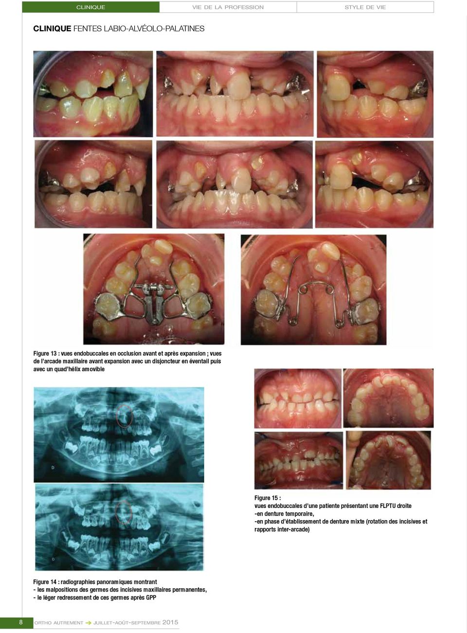 temporaire, -en phase d établissement de denture mixte (rotation des incisives et rapports inter-arcade) Figure 14 : radiographies panoramiques montrant -