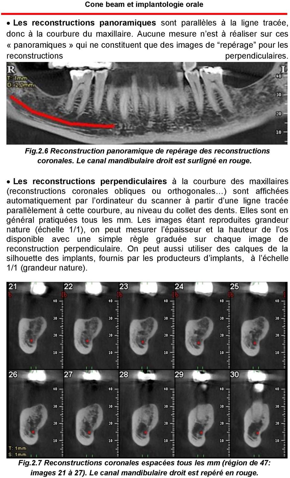 6 Reconstruction panoramique de repérage des reconstructions coronales. Le canal mandibulaire droit est surligné en rouge.