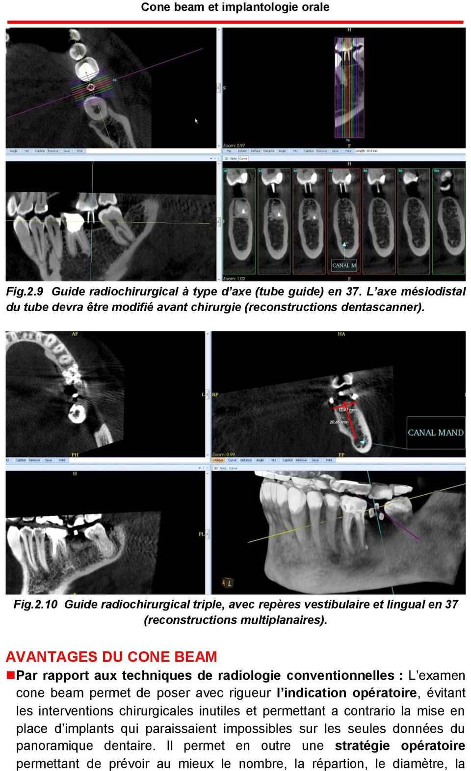 chirurgicales inutiles et permettant a contrario la mise en place d implants qui paraissaient impossibles sur les seules données du panoramique dentaire.