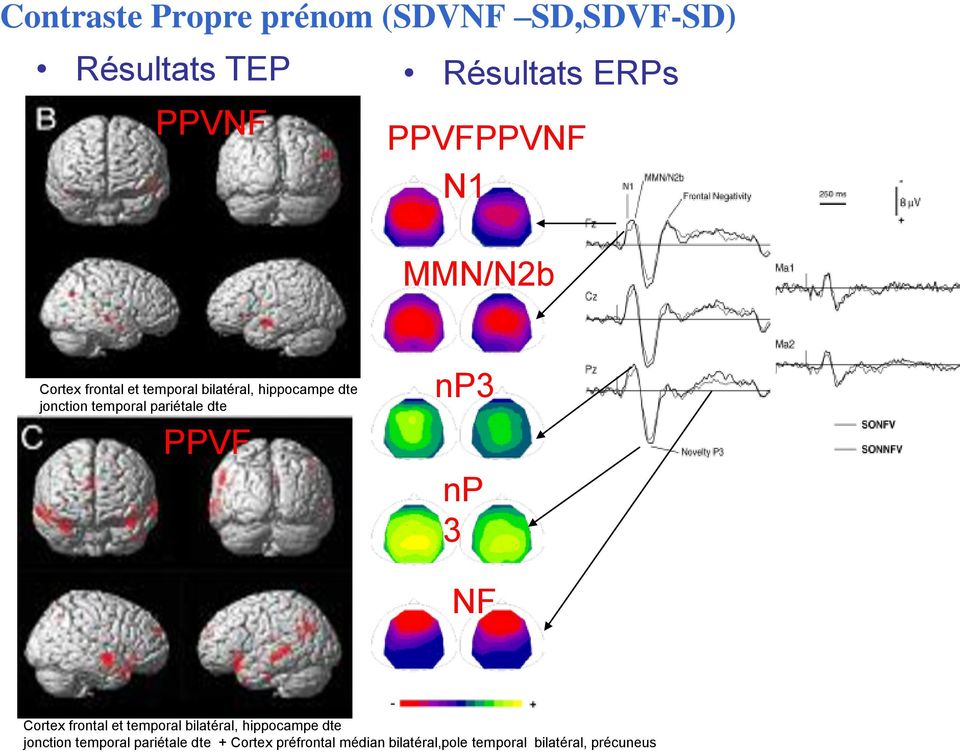 pariétale dte PPVF np3 np 3 NF Cortex frontal et temporal bilatéral, hippocampe dte