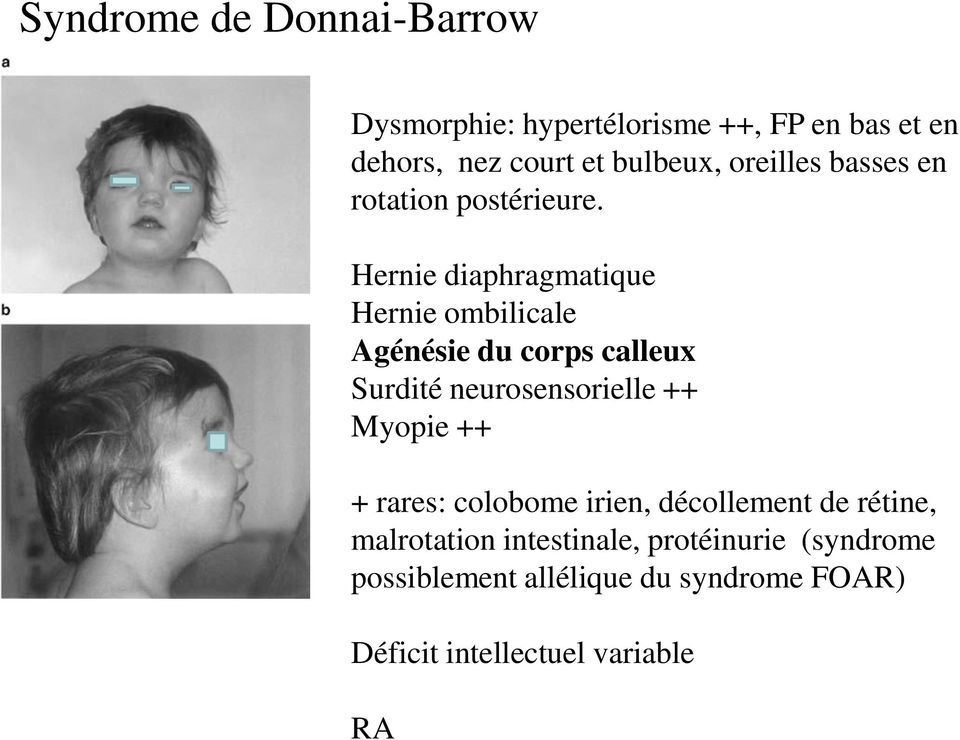 Hernie diaphragmatique Hernie ombilicale Agénésie du corps calleux Surdité neurosensorielle ++ Myopie ++