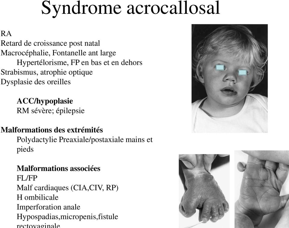 RM sévère; épilepsie Malformations des extrémités Polydactylie Preaxiale/postaxiale mains et pieds