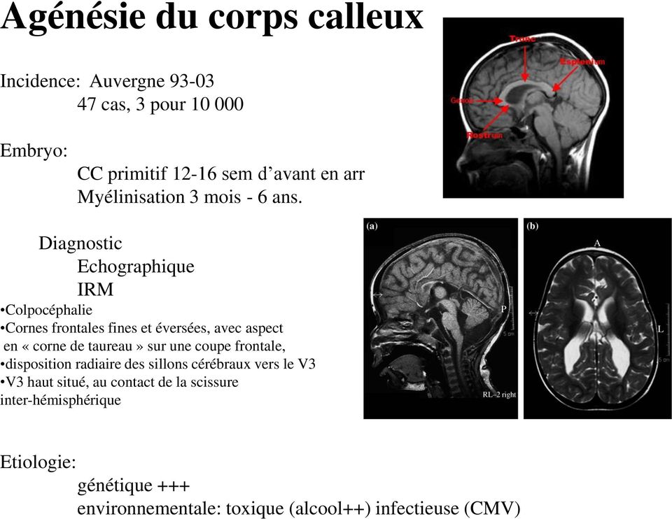 Diagnostic Echographique IRM Colpocéphalie Cornes frontales fines et éversées, avec aspect en «corne de taureau» sur