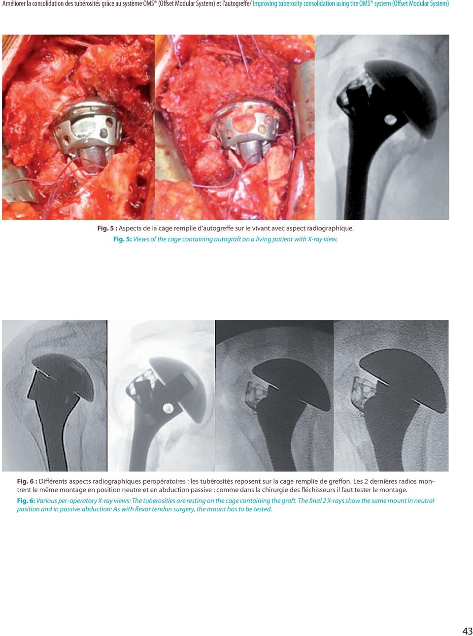 5: Views of the cage containing autograft on a living patient with X-ray view. Fig. 6 : Différents aspects radiographiques peropératoires : les tubérosités reposent sur la cage remplie de greffon.