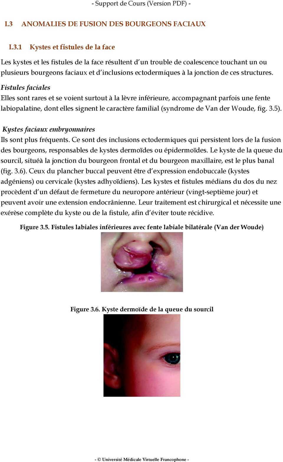 Fistules faciales Elles sont rares et se voient surtout à la lèvre inférieure, accompagnant parfois une fente labiopalatine, dont elles signent le caractère familial (syndrome de Van der Woude, fig.