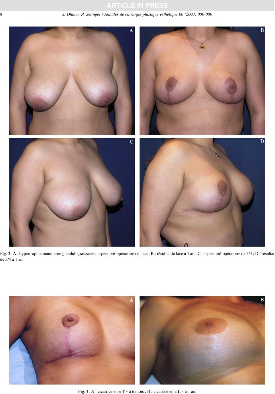 A : hypertrophie mammaire glandulograisseuse, aspect pré-opératoire de face; B: