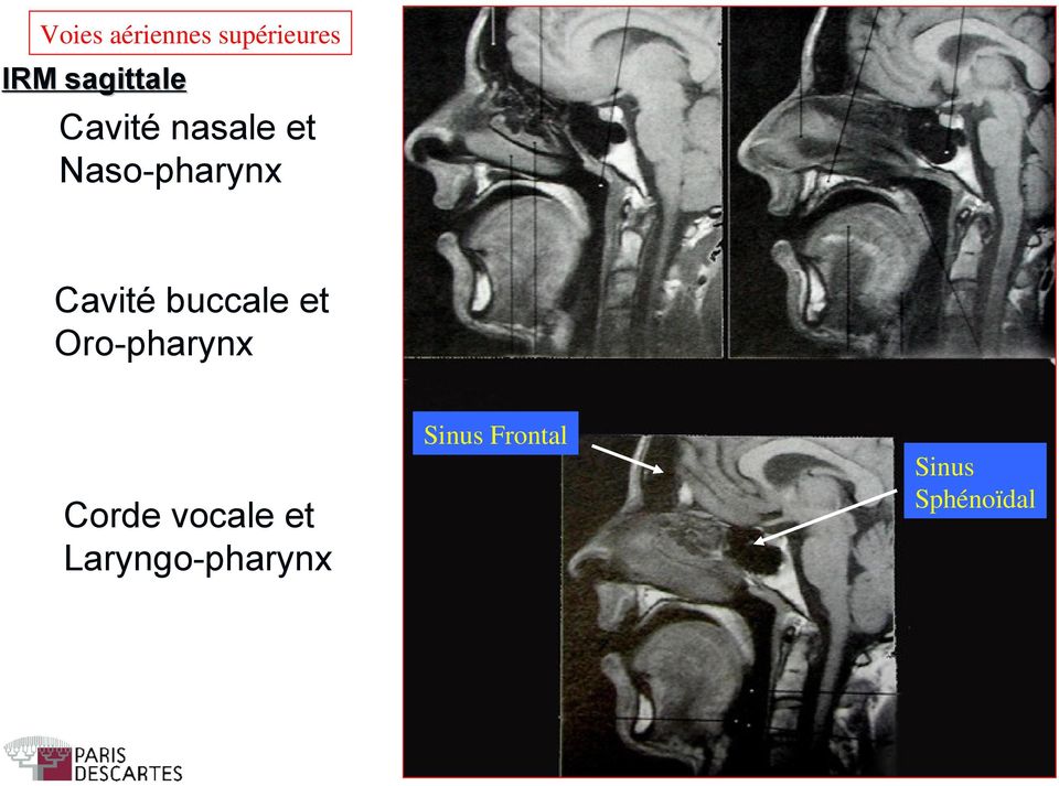 buccale et Oro-pharynx Sinus Frontal