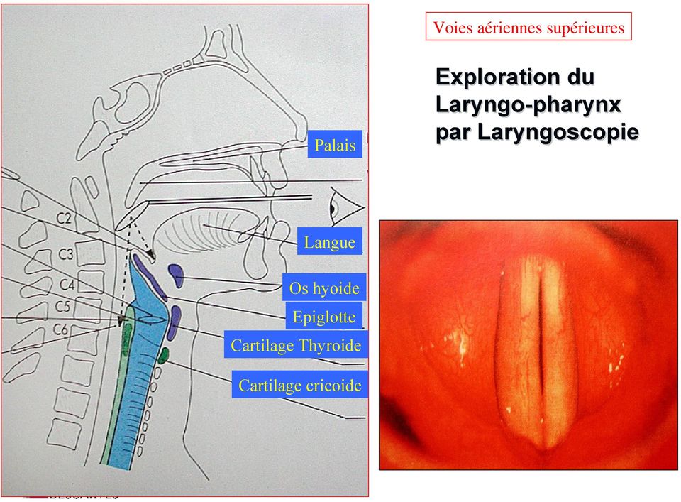 Laryngoscopie Langue Os hyoide