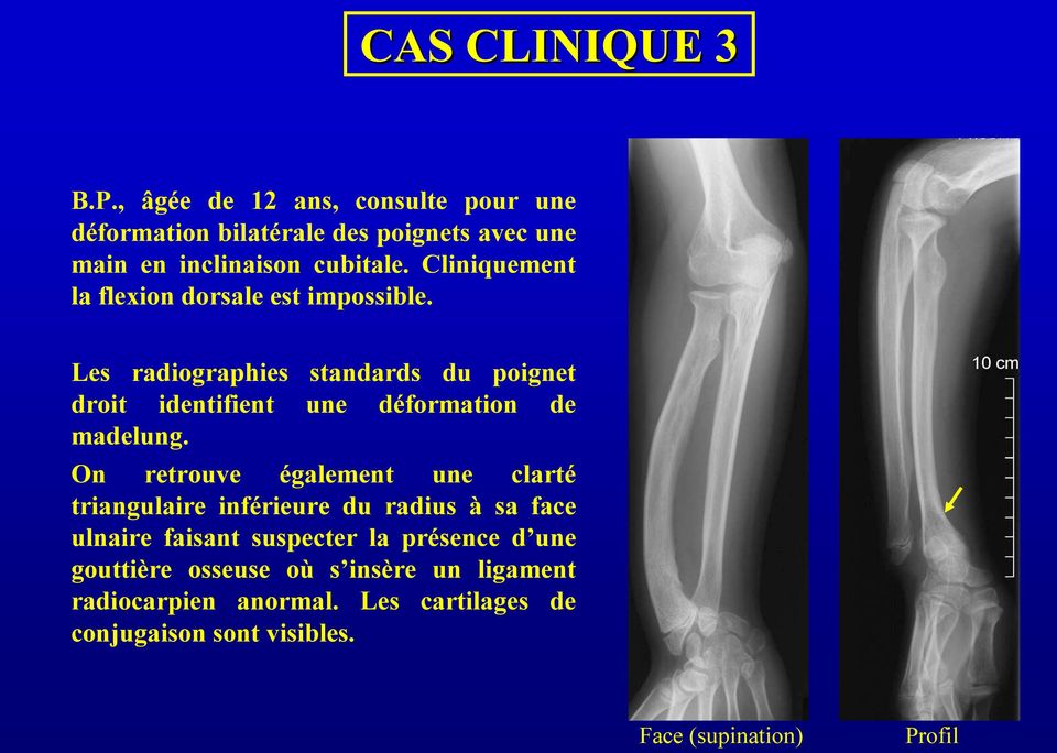 Les radiographies standards du poignet droit identifient une déformation de madelung.