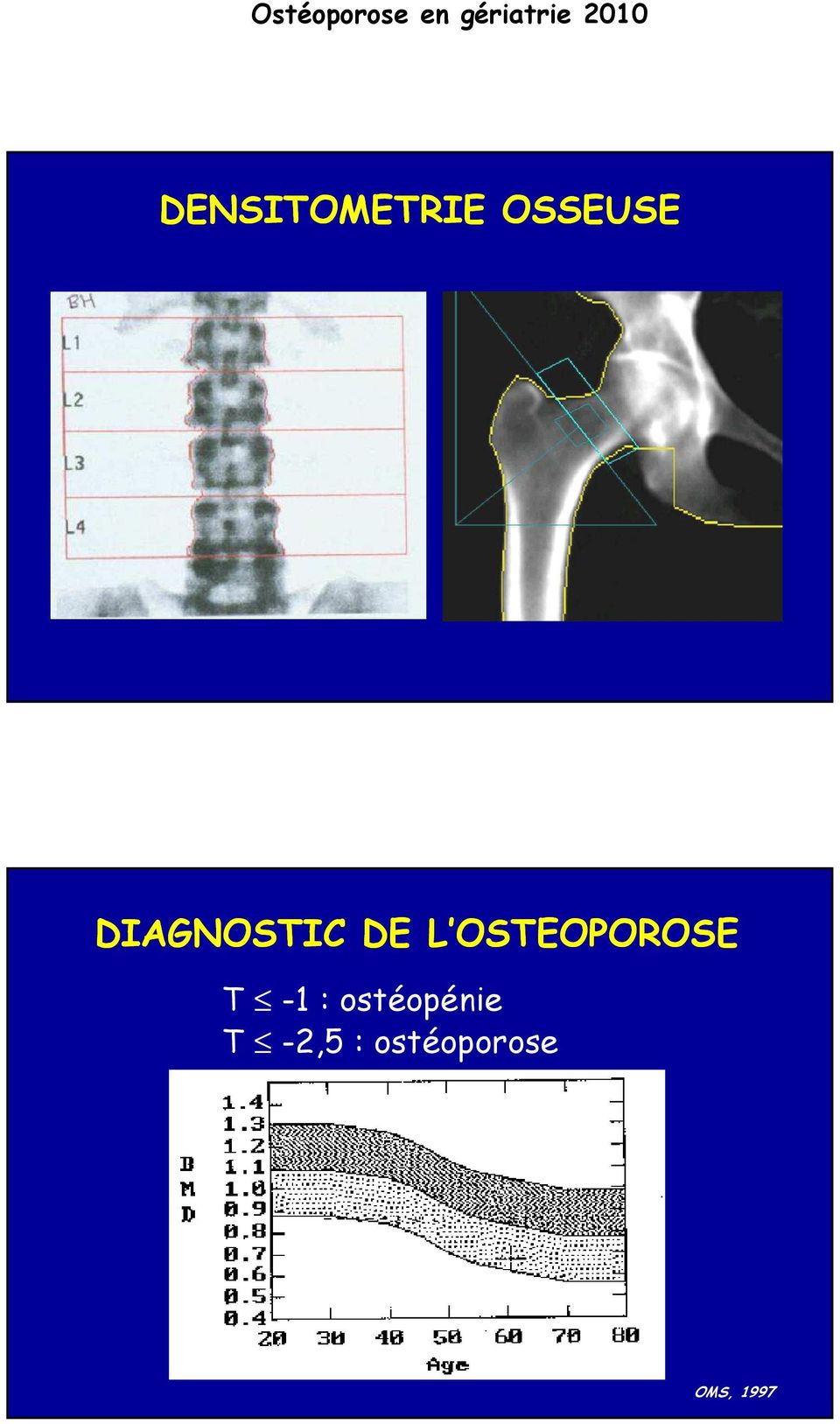 OSTEOPOROSE T -1 :