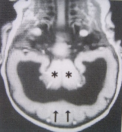 Holoprosencéphalie Défaut de développement du massif facial entraînant une absence de diverticulisation du cerveau.