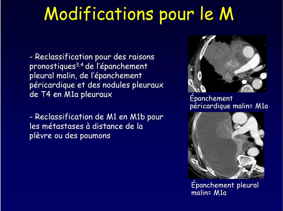 T4 en M1a pleuraux - Reclassification de M1 en M1b pour les métastases à distance de