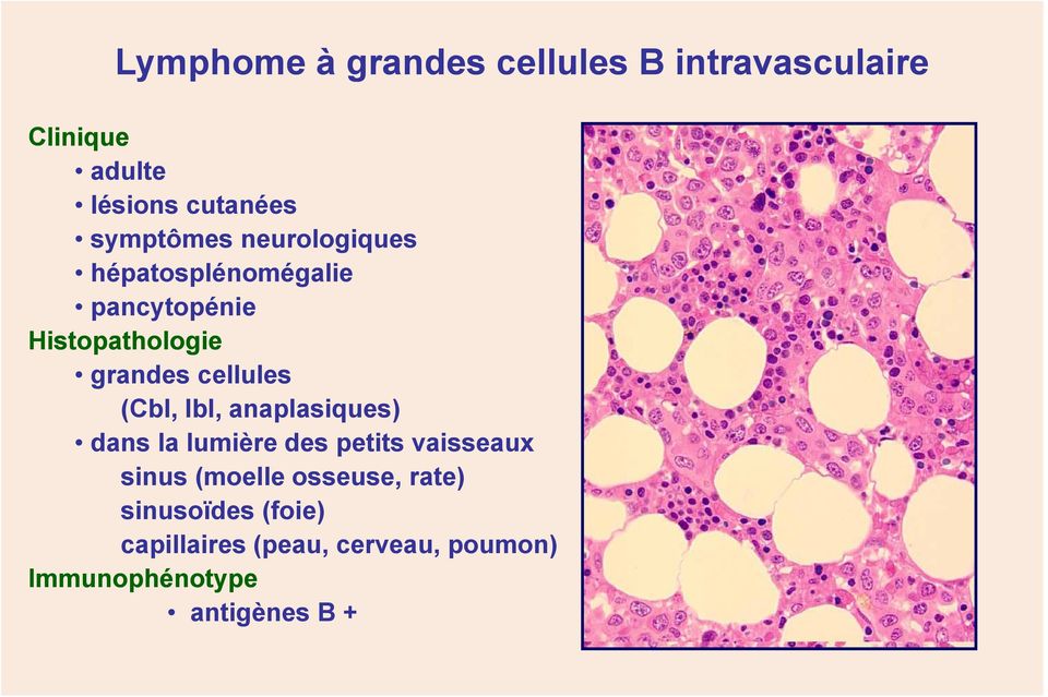 cellules (Cbl, Ibl, anaplasiques) dans la lumière des petits vaisseaux sinus (moelle