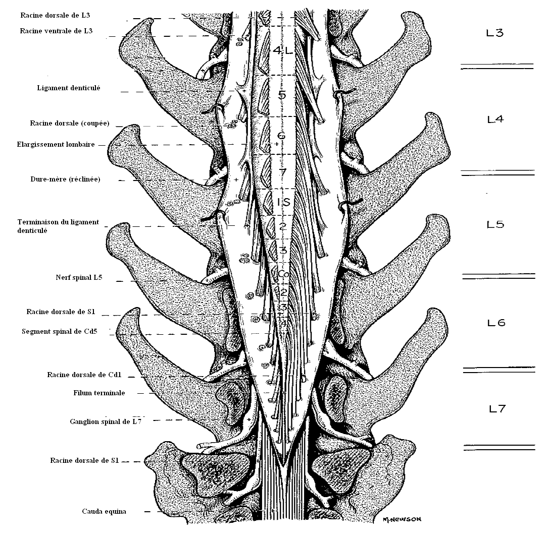 peut affecter plusieurs segments médullaires et plusieurs racines de nerfs spinaux, aboutissant à un tableau clinique varié [2].
